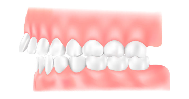 出っ歯（上顎前突：じょうがくぜんとつ）