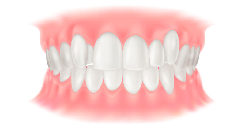 八重歯・乱ぐい歯（叢生：そうせい）