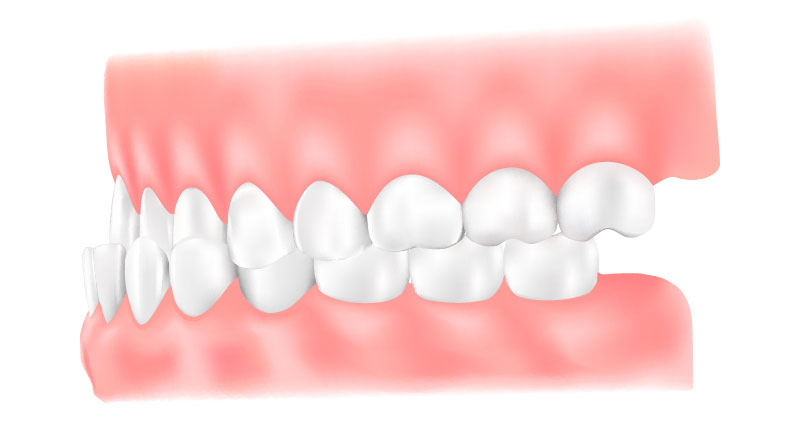 受け口（下顎前突：かがくぜんとつ）