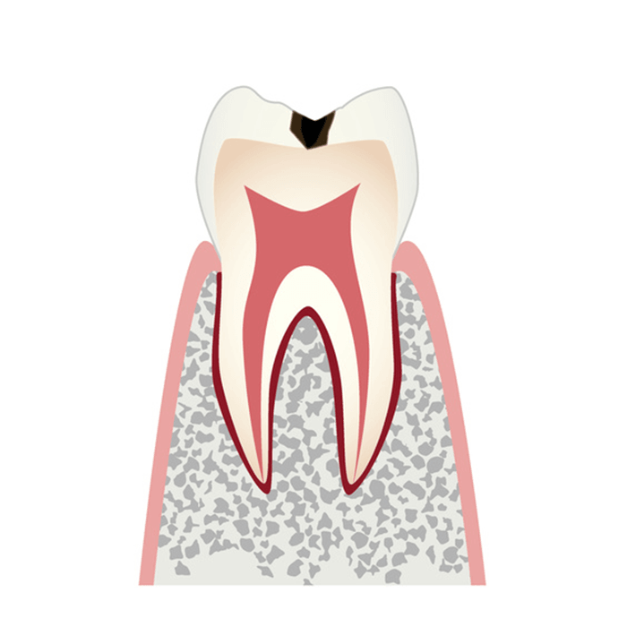 エナメル質に小さな穴が空いたむし歯（C1）