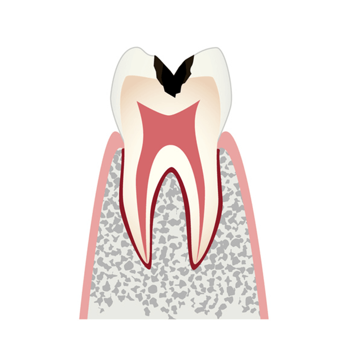 象牙質まで進行したむし歯（C2）