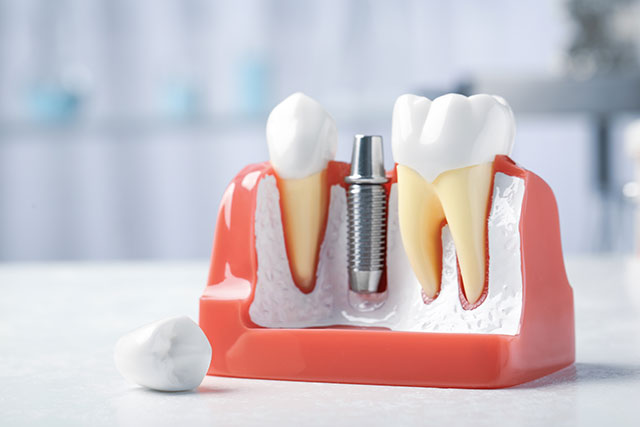 インプラント