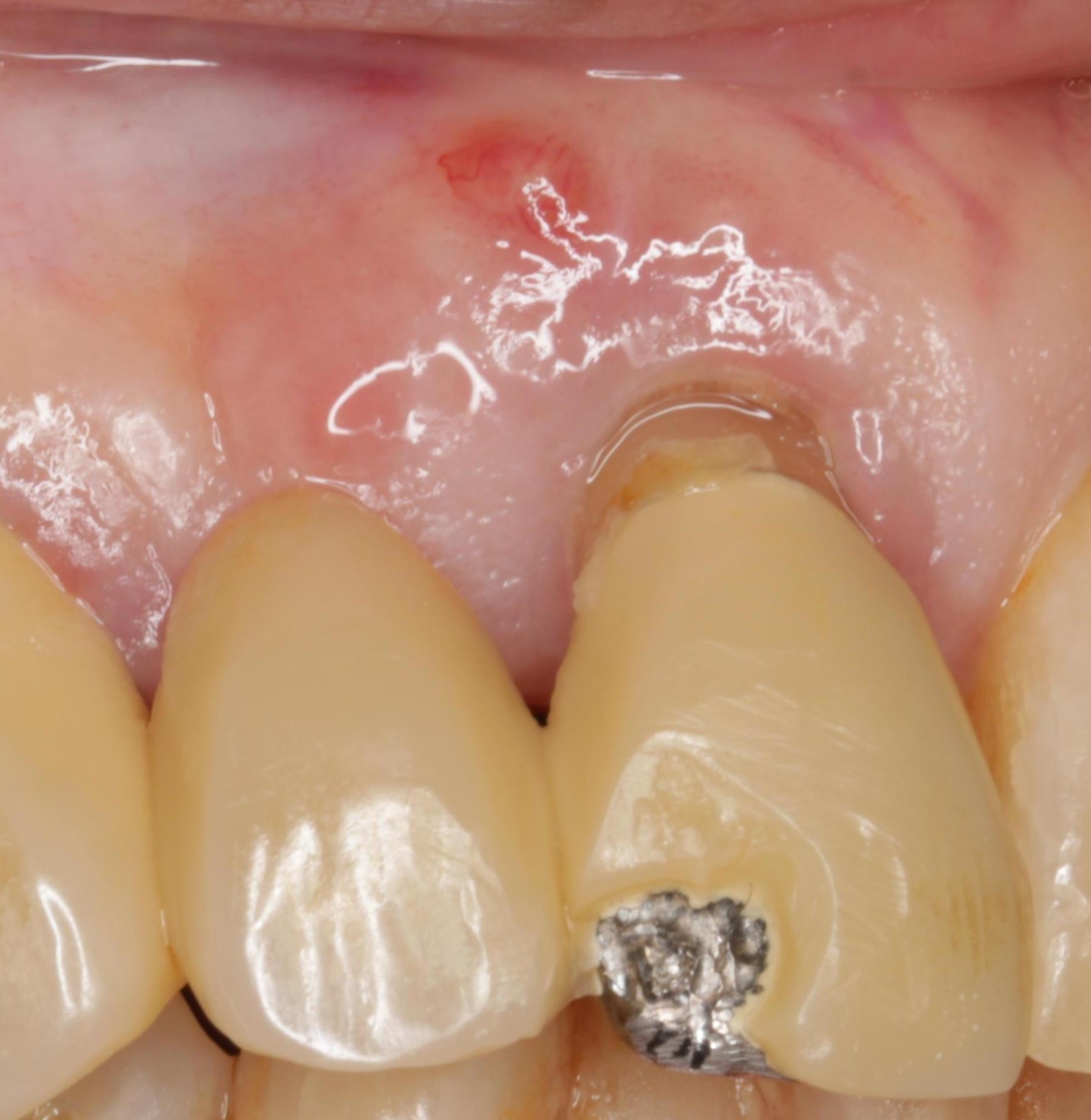 根管治療後にセラミッククラウンで修復した症例｜東京・四谷三丁目の歯医者