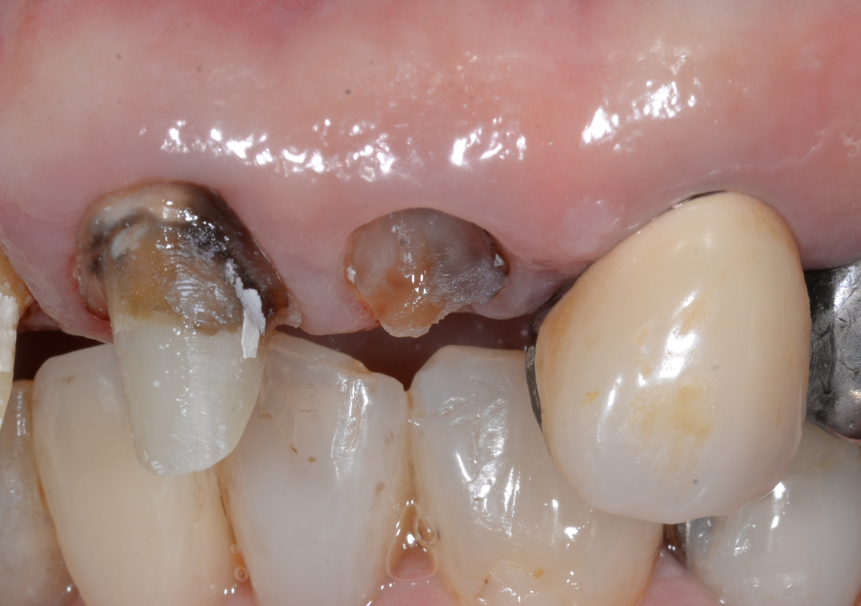 歯をできるだけ抜かない治療｜抜歯と言われた歯は残せる？東京・四谷三丁目の歯科