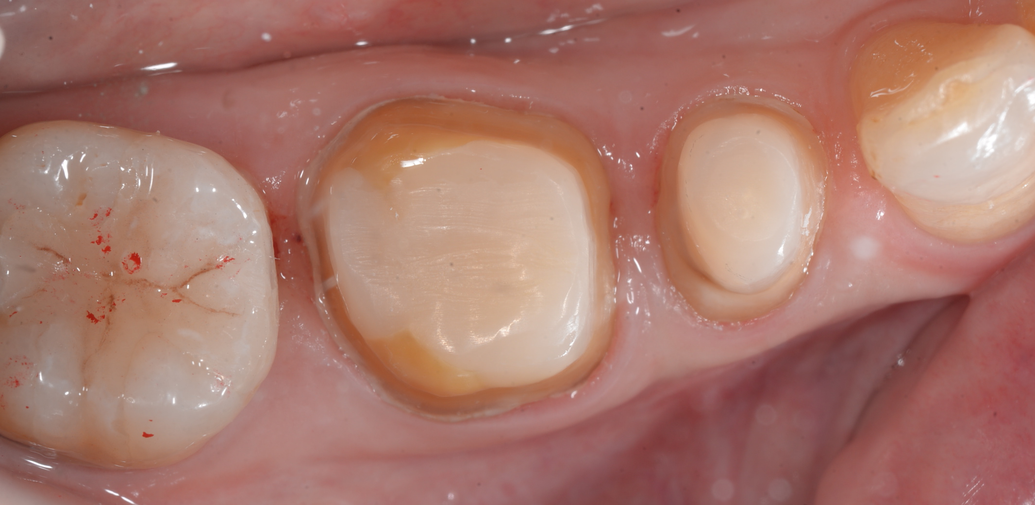 根管治療後にセラミッククラウンで修復した症例｜東京・四谷三丁目の歯医者