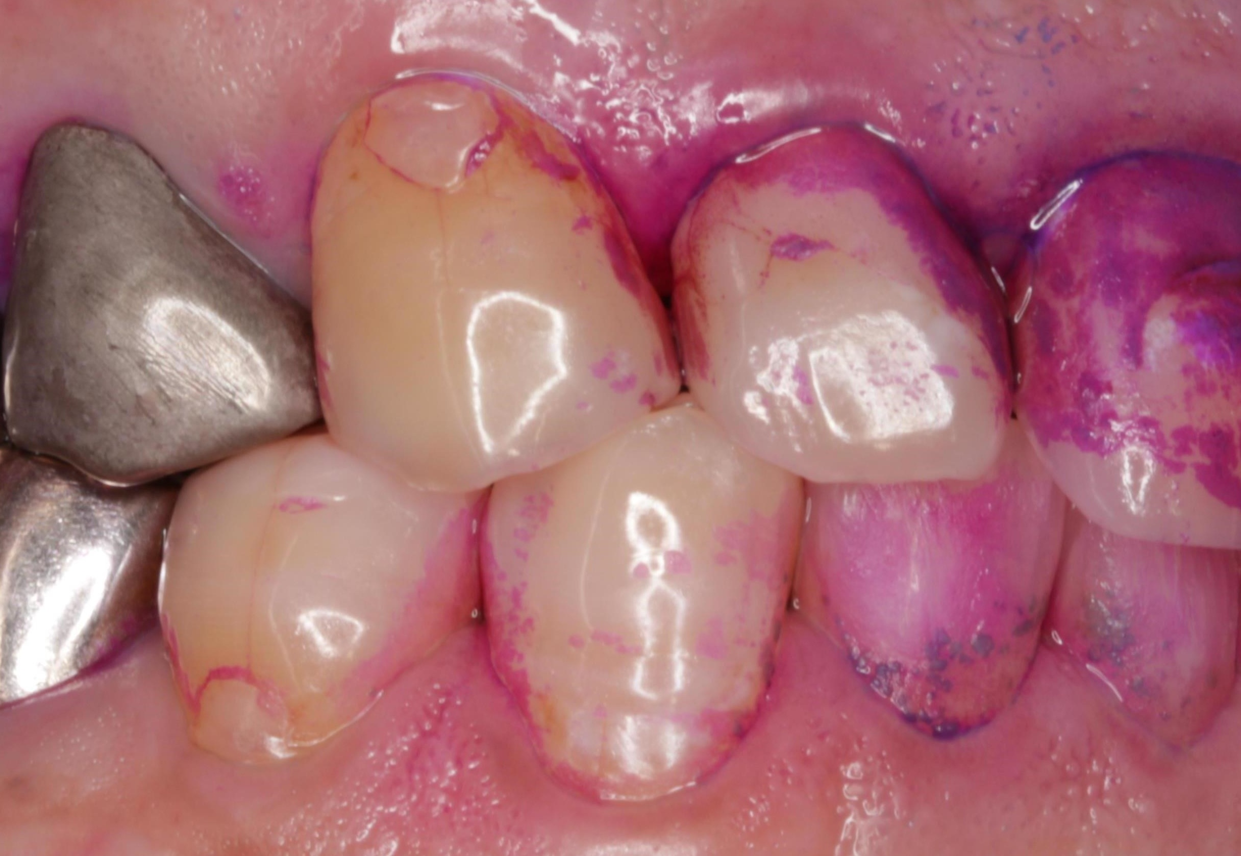 口臭の原因と対策｜四谷三丁目の歯医者（衛生士が解説）
